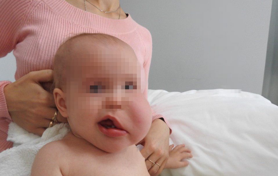 Хірург з Волині Валіхновський прооперував немовля з пухлиною на обличчі. ФОТО