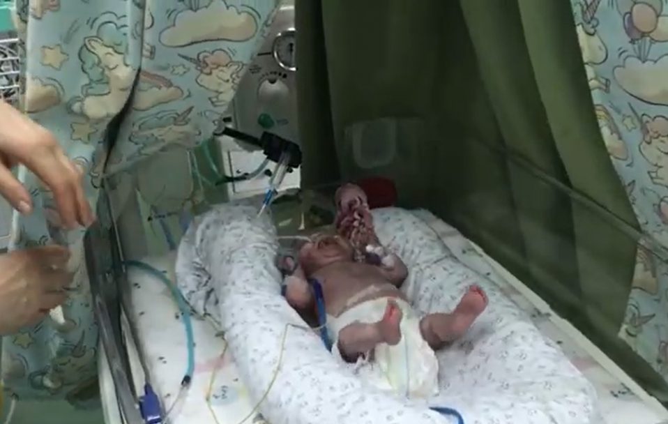 У Луцьку врятували дитину, яка народилася з вагою 420 грамів. ВІДЕО